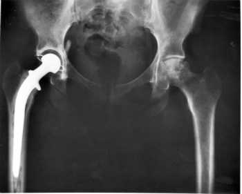hip-replacement-medical-malpractice